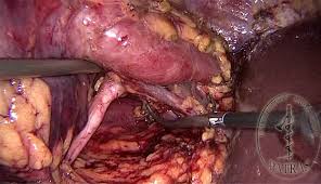 laparoscopic nefrectomy 