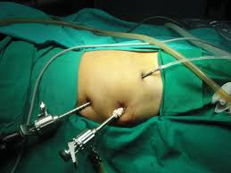 kidney laparoscopic surgery 