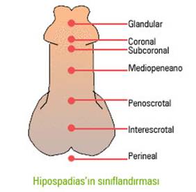 hipospadias